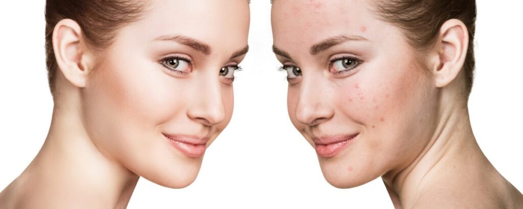 10 Home Remedies to get rid of Acne and Pimples